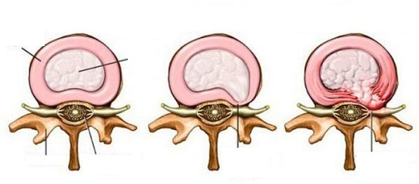 hérnia intervertebral com osteocondrose cervical
